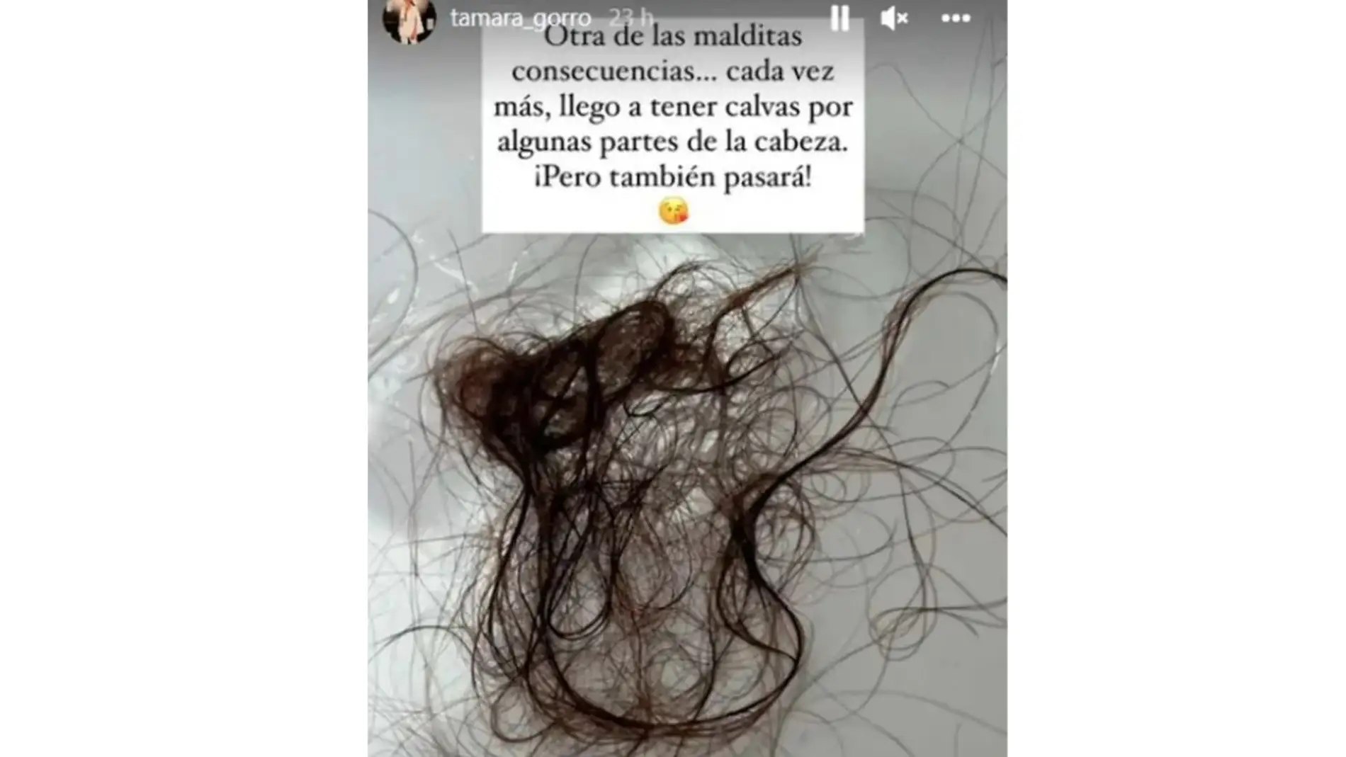 Tamara Gorro muestra su caída de pelo