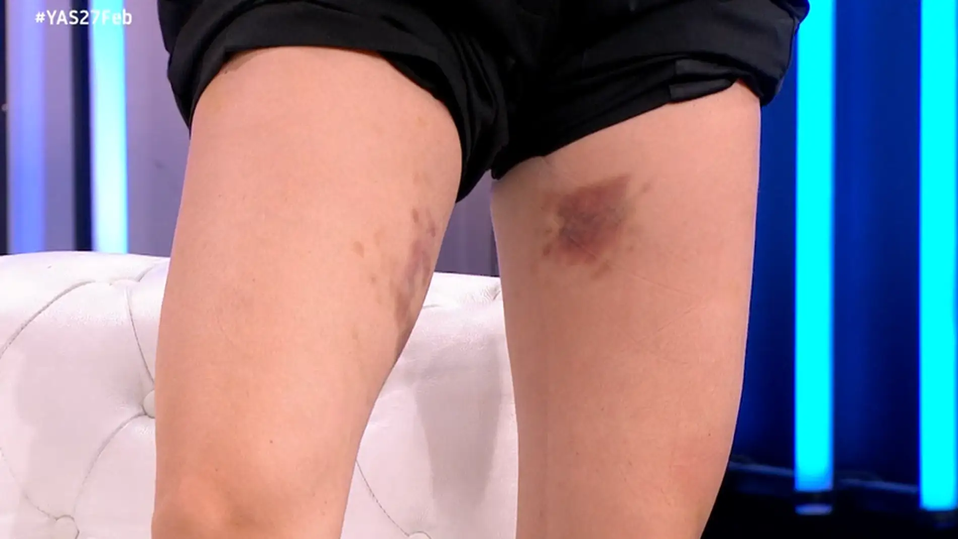 Los moratones de Eva Soriano por los ensayos de 'El Desafío' Los moratones de Eva Soriano por los ensayos de 'El Desafío'