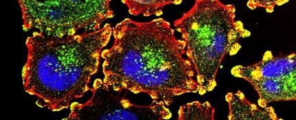 Imagen de células cancerosas