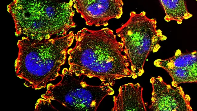 Imagen de células cancerosas