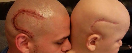 Un padre se tatúa la cicatriz de su hijo para que se sienta normal