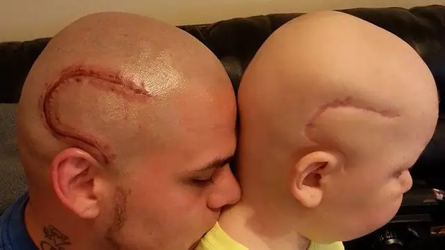 Un padre se tatúa la cicatriz de su hijo para que se sienta normal