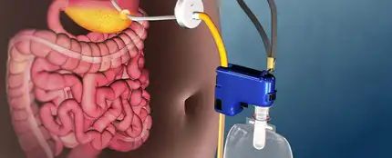 AspireAssist, el polémico método de pérdida de peso AspireAssist, el polémico método de pérdida de peso