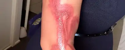 Las quemaduras que ha sufrido en el brazo Las quemaduras que ha sufrido en el brazo
