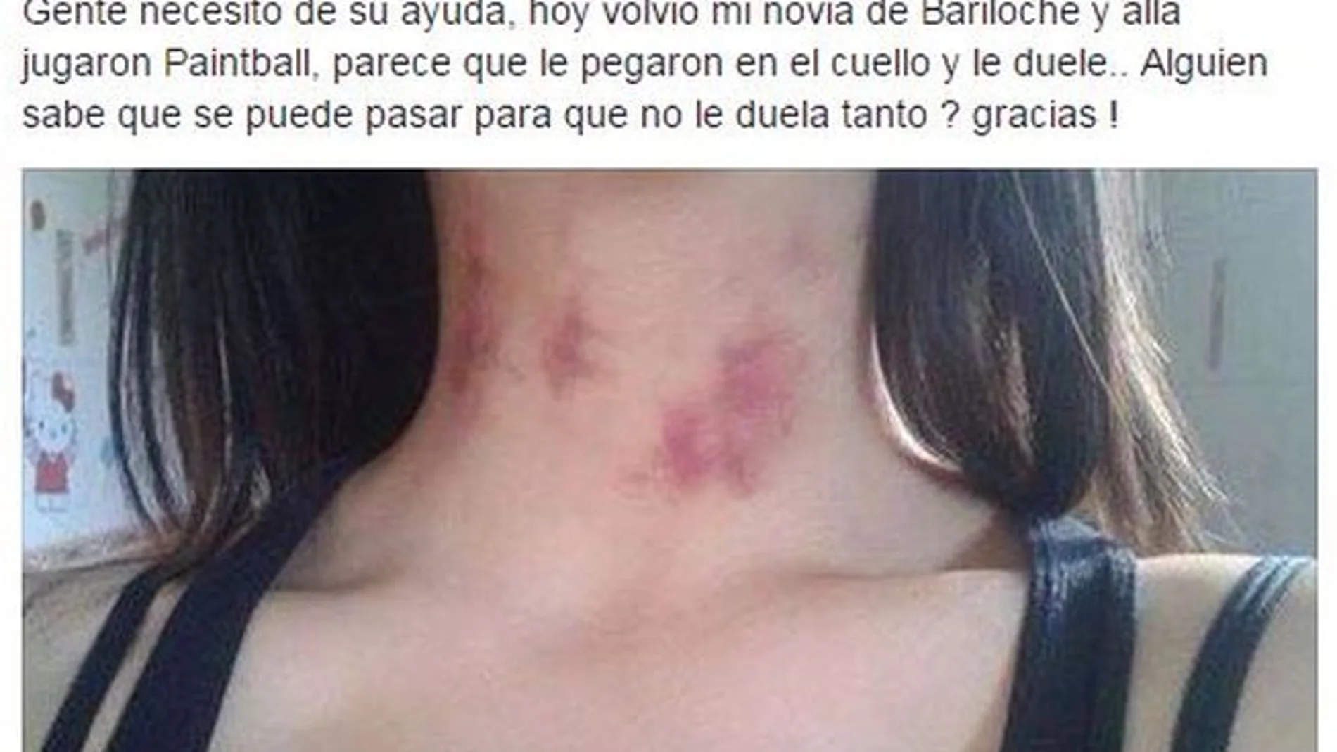 Un chico pide ayuda por los moratones de su novia y la red le explica que son chupetones Un chico pide ayuda por los moratones de su novia y la red le explica que son chupetones