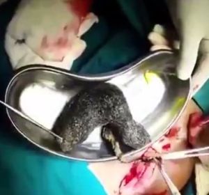Extraen una bola de pelo del estómago de un paciente Extraen una bola de pelo del estómago de un paciente
