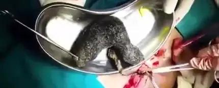 Extraen una bola de pelo del estómago de un paciente Extraen una bola de pelo del estómago de un paciente