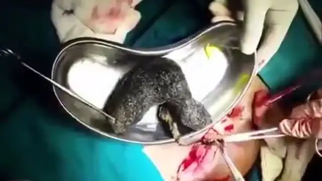 Extraen una bola de pelo del estómago de un paciente