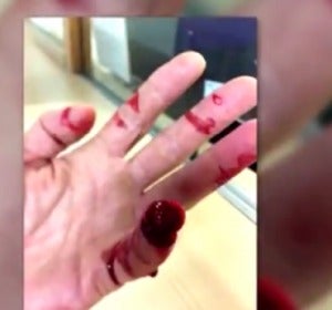 Así quedó la mano del agente agredido Así quedó la mano del agente agredido