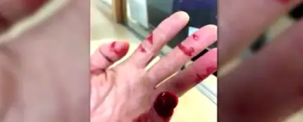 Así quedó la mano del agente agredido Así quedó la mano del agente agredido