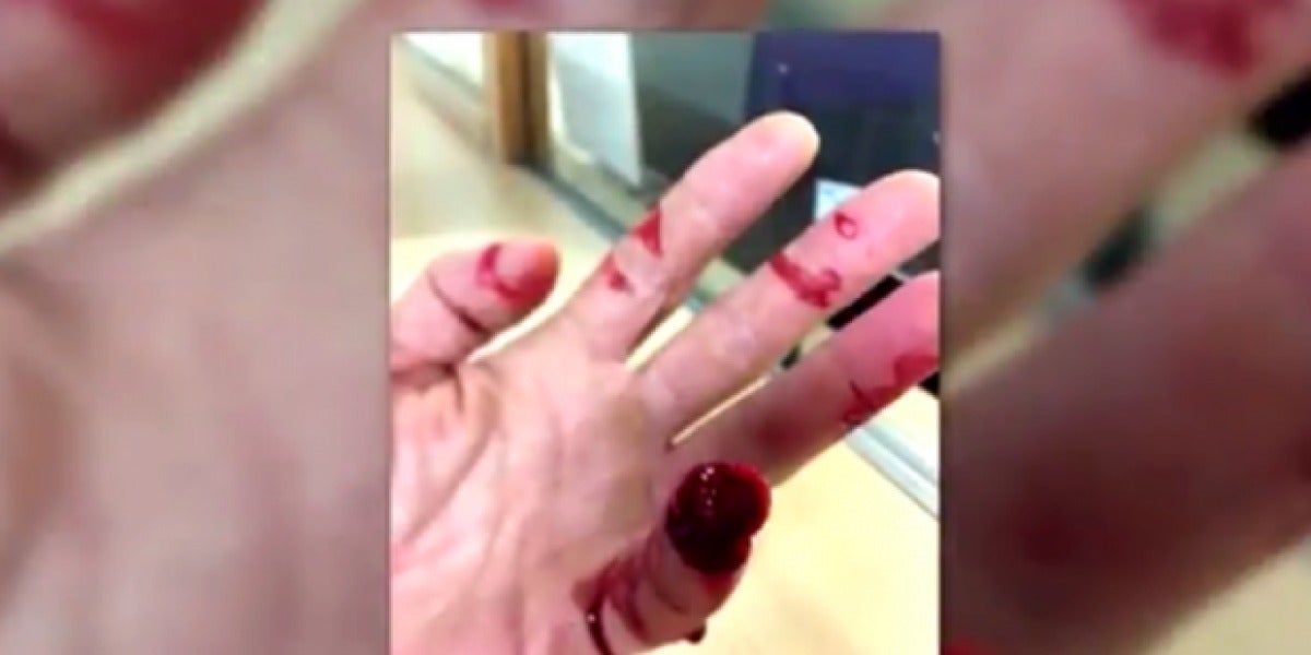 Así quedó la mano del agente agredido