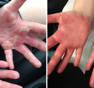 Una niña sufre quemaduras en las manos tras hacer slime casero con bórax Una niña sufre quemaduras en las manos tras hacer slime casero con bórax
