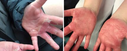 Una niña sufre quemaduras en las manos tras hacer slime casero con bórax