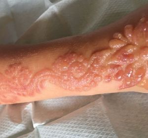 Quemaduras producidas a una niña de siete años por una tatuaje de henna Quemaduras producidas a una niña de siete años por una tatuaje de henna