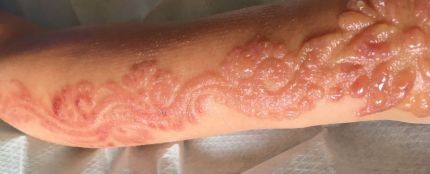 Quemaduras producidas a una niña de siete años por una tatuaje de henna
