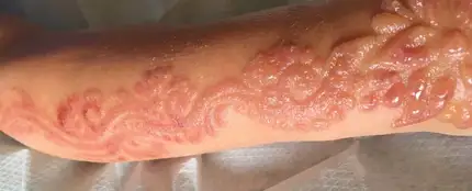Quemaduras producidas a una niña de siete años por una tatuaje de henna Quemaduras producidas a una niña de siete años por una tatuaje de henna