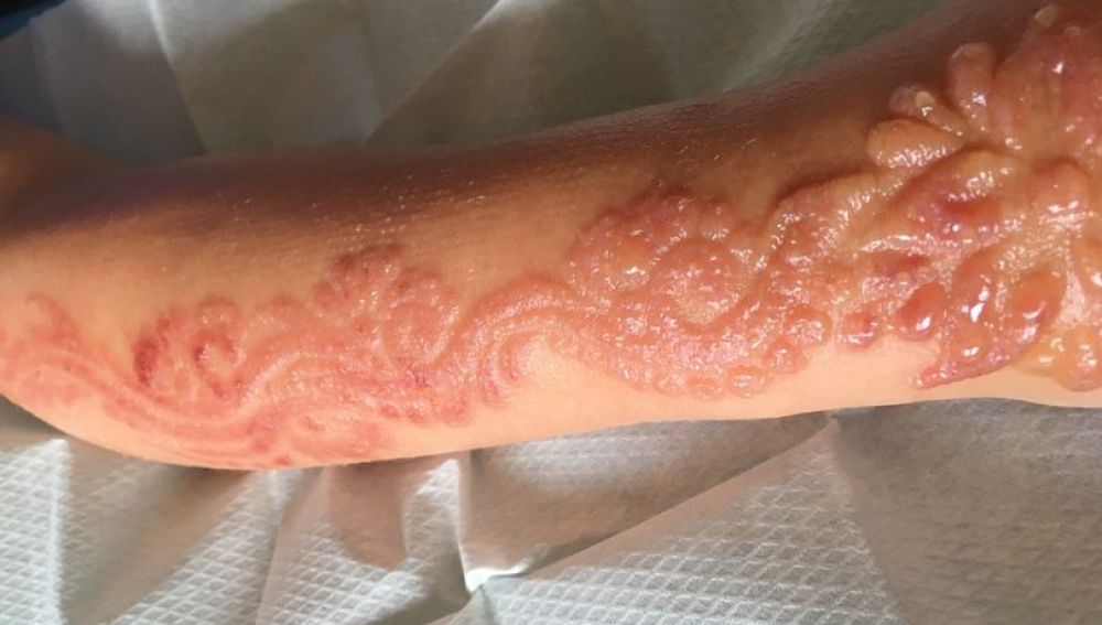 Quemaduras producidas a una niña de siete años por una tatuaje de henna