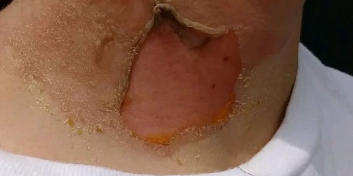 Quemaduras de Conrad, víctima del 'hot water challenge'