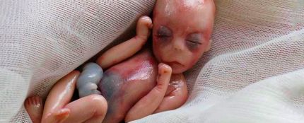 Willow, la bebé que nació muerta con 5 meses