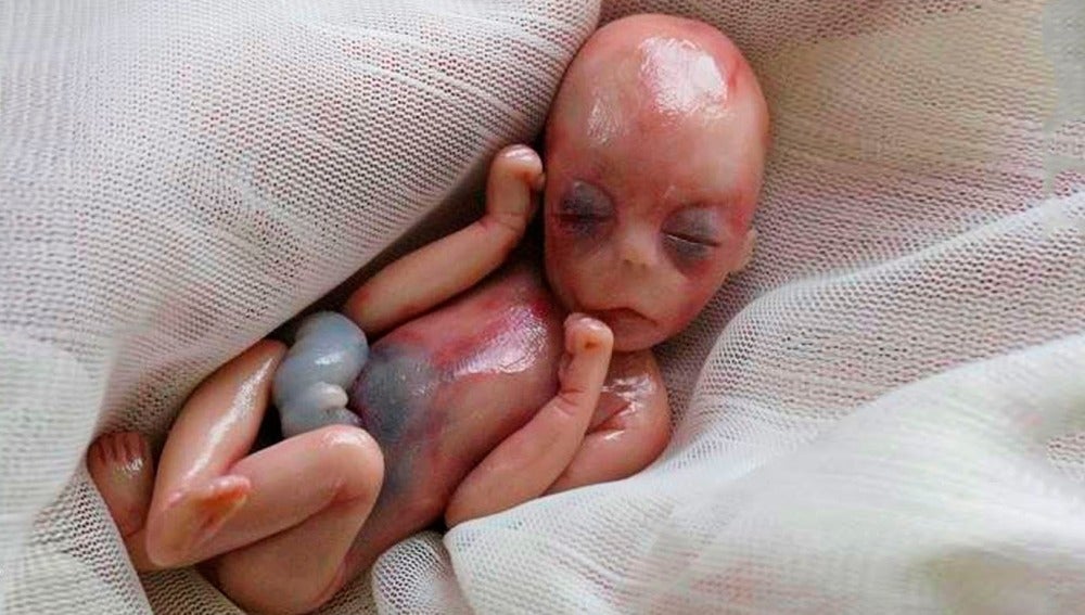 Willow, la bebé que nació muerta con 5 meses