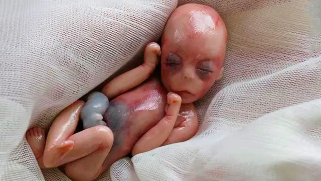 Willow, la bebé que nació muerta con 5 meses