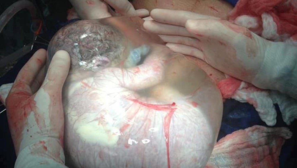 Un bebé recién nacido dentro de la bolsa amniótica