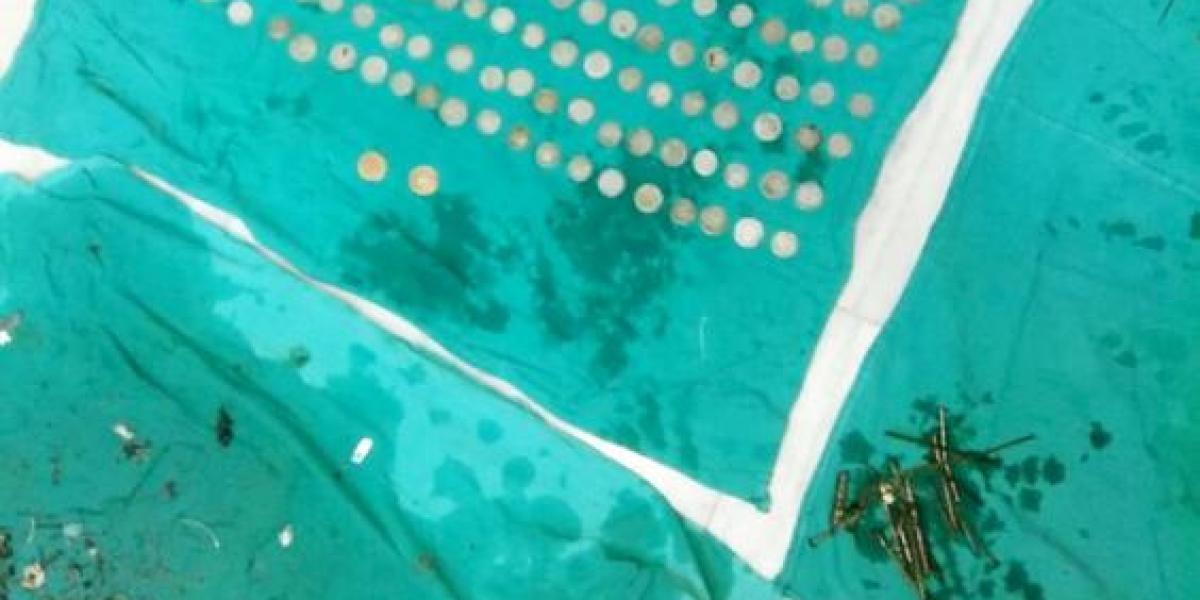 Las monedas y los clavos encontrados en el estómago del paciente