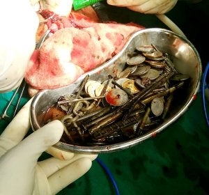 Extraen 263 monedas del cuerpo de un paciente, además de clavos y cuchillas de afeitar Extraen 263 monedas del cuerpo de un paciente, además de clavos y cuchillas de afeitar
