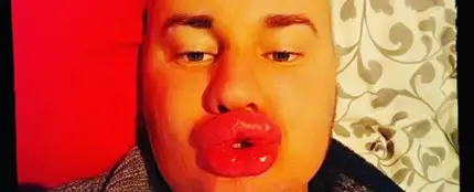 Un joven se gasta más de 5.500€ en botox para parecerse a Marilyn Monroe Un joven se gasta más de 5.500€ en botox para parecerse a Marilyn Monroe