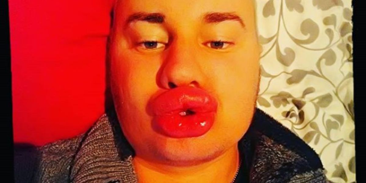 Un joven se gasta más de 5.500€ en botox para parecerse a Marilyn Monroe
