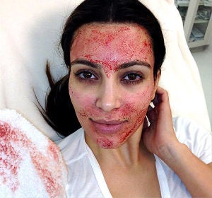 Kim Kardashian inyectándose en la cara su propia sangre Kim Kardashian inyectándose en la cara su propia sangre