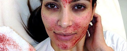 Kim Kardashian inyect&aacute;ndose en la cara su propia sangre