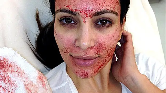 Kim Kardashian inyectándose en la cara su propia sangre