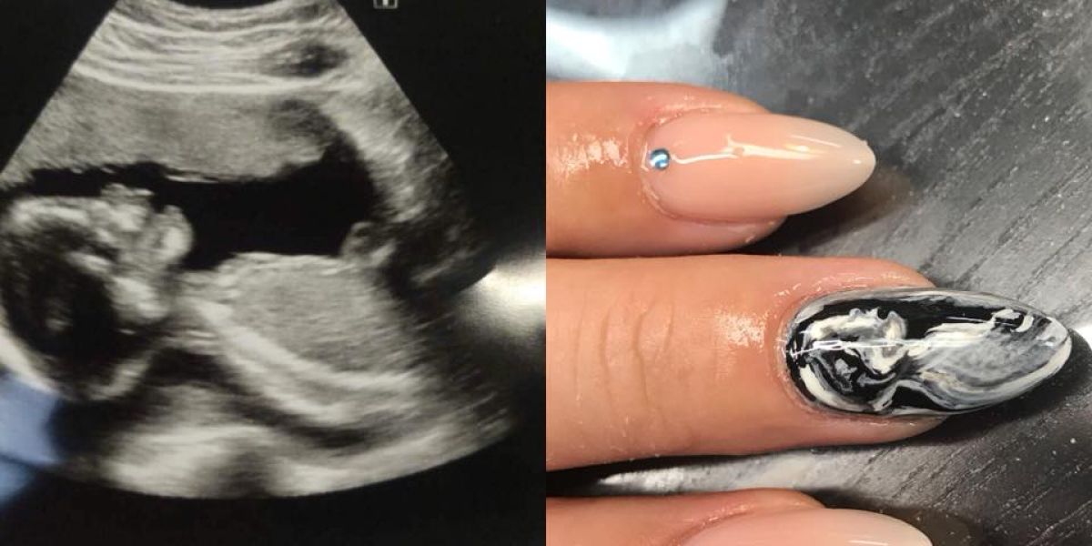 Imagen de la manicura con la ecografía escaneada