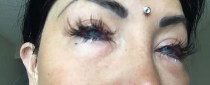 Nadinne Bruna tras la operación para cambiar su color de ojos
