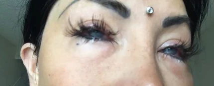 Nadinne Bruna tras la operación para cambiar su color de ojos Nadinne Bruna tras la operación para cambiar su color de ojos