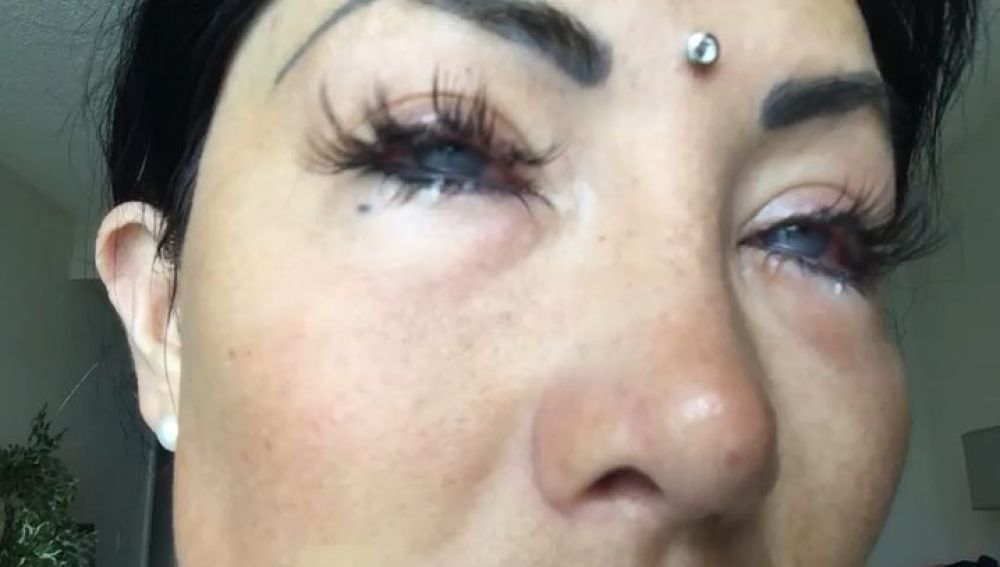 Nadinne Bruna tras la operación para cambiar su color de ojos