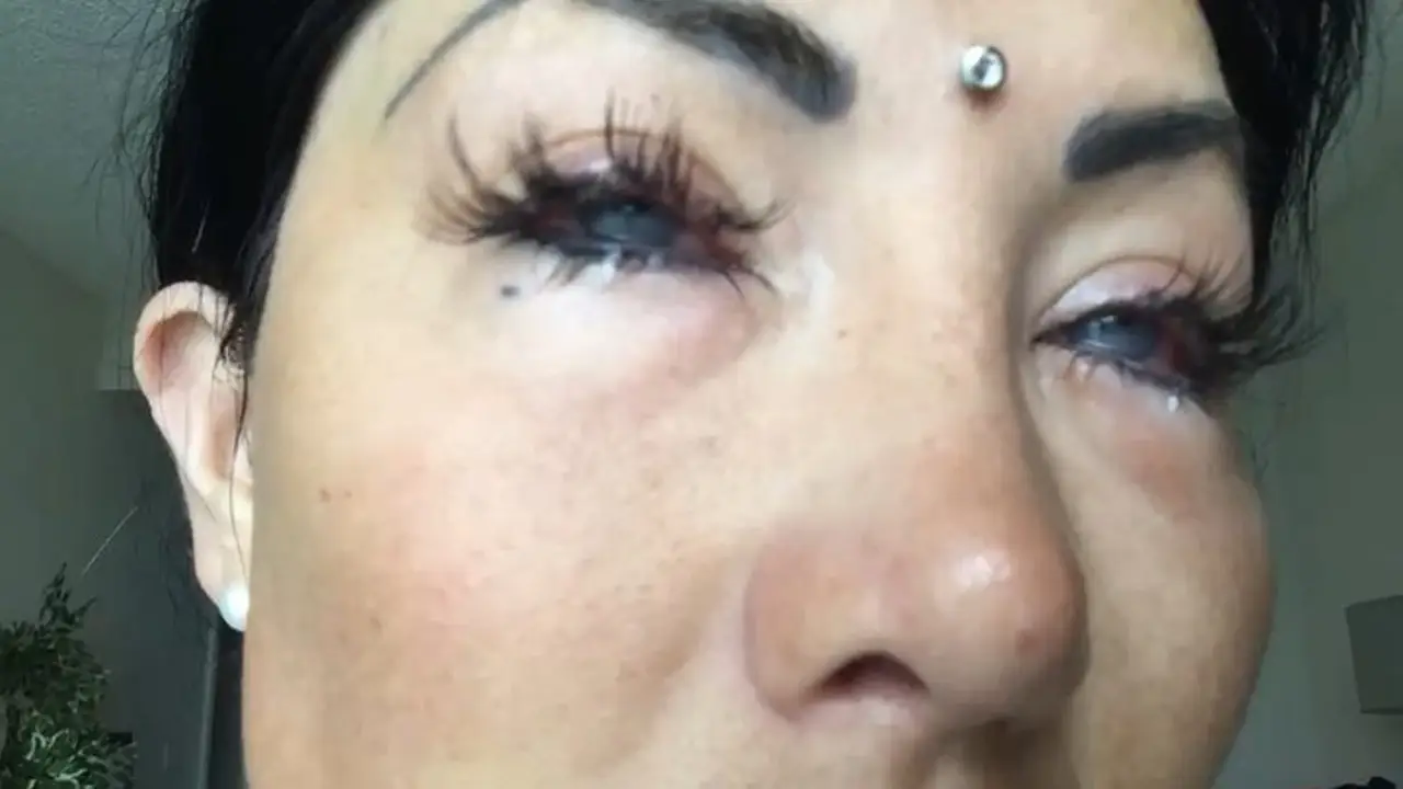 Nadinne Bruna tras la operación para cambiar su color de ojos Nadinne Bruna tras la operación para cambiar su color de ojos