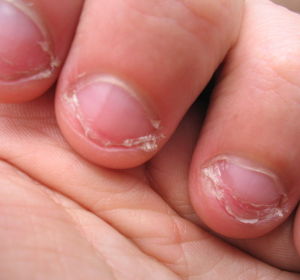 Uñas mordidas Uñas mordidas