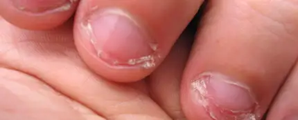 Uñas mordidas Uñas mordidas