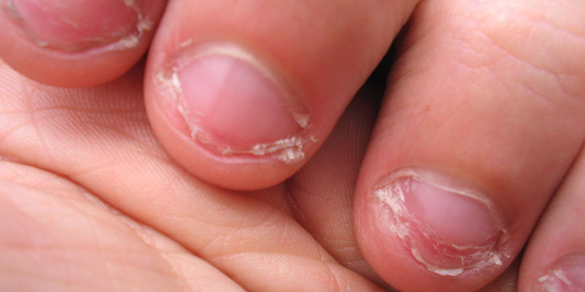 Uñas mordidas