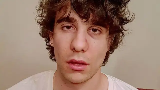 Javier Calvo muestra su cara tras la agresión en Lisboa