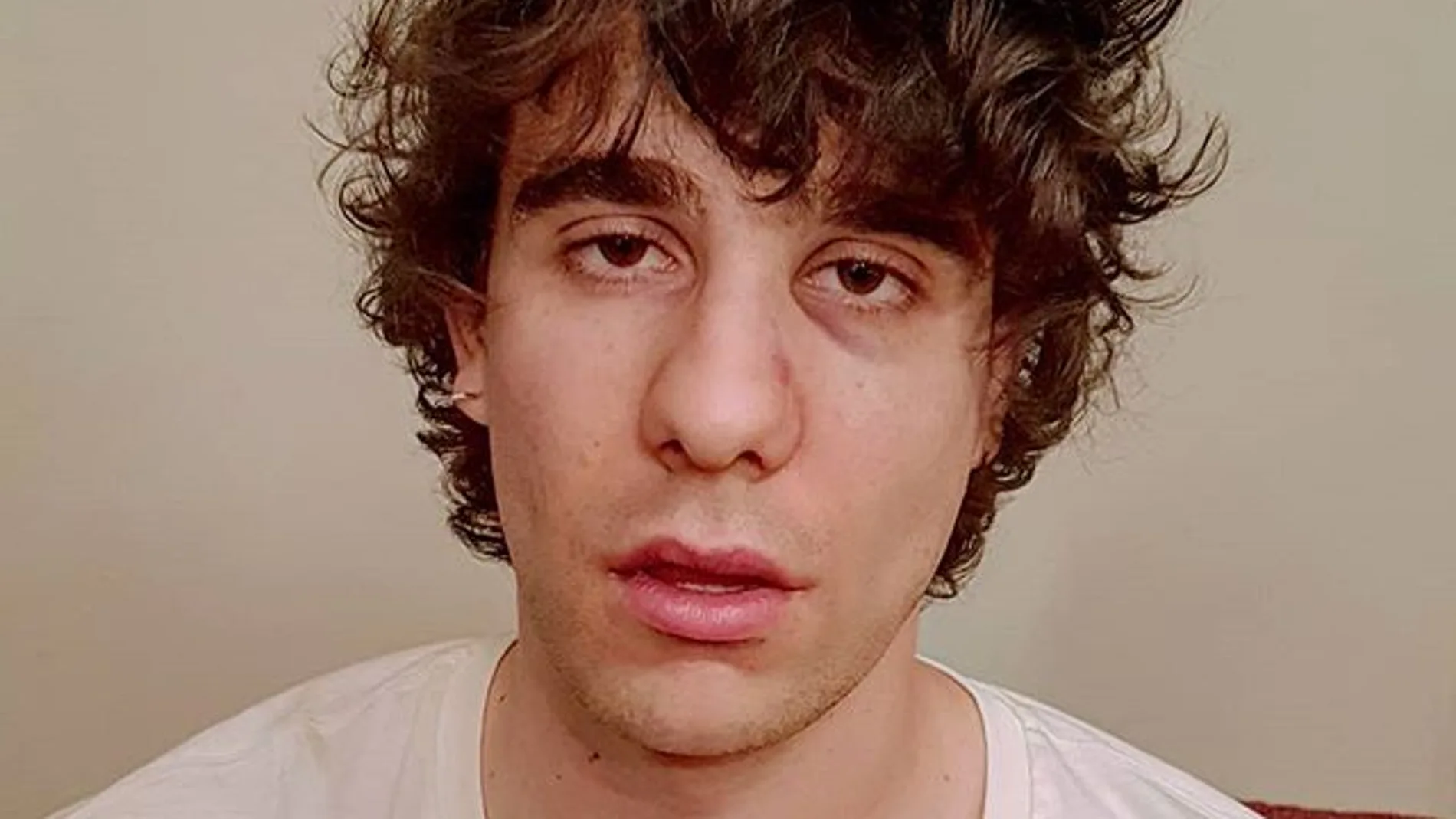 Javier Calvo muestra su cara tras la agresión en Lisboa Javier Calvo muestra su cara tras la agresión en Lisboa