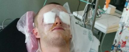 Imagen del joven escocés que recibió un disparo en los ojos con una pistola de pintura en Magaluf