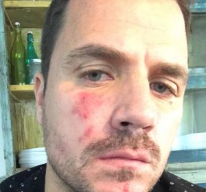 Dani Martín muestra su cara con rosácea Dani Martín muestra su cara con rosácea