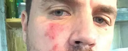 Dani Martín muestra su cara con rosácea Dani Martín muestra su cara con rosácea