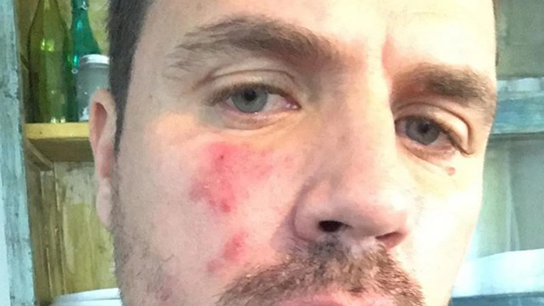 Dani Martín muestra su cara con rosácea Dani Martín muestra su cara con rosácea