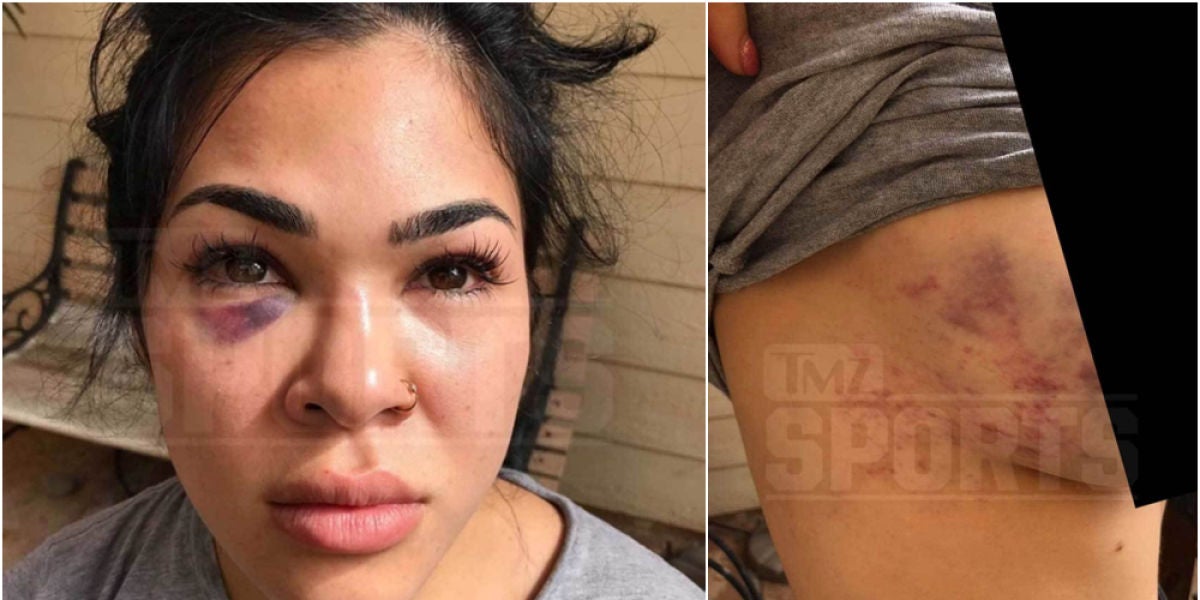 Rachael Ostovich muestra sus heridas tras la agresión de su marido