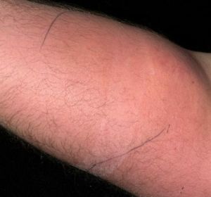 Inyección de semen en el antebrazo Inyección de semen en el antebrazo