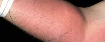 Inyección de semen en el antebrazo Inyección de semen en el antebrazo